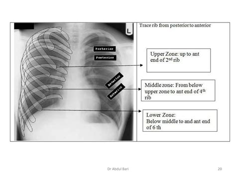 Image result for Chest X-Ray Tutorial