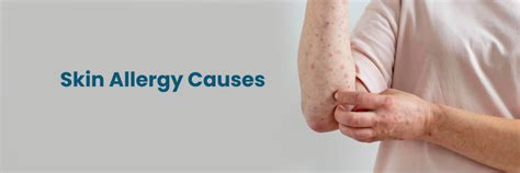 Common Causes of Skin Allergy