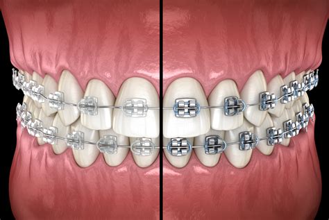 Metal Braces With White Rubber Bands at Robin Alexander blog
