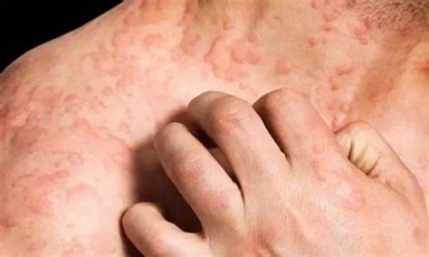 Positive Phase III Results Emerge for Remibrutinib in Chronic ...