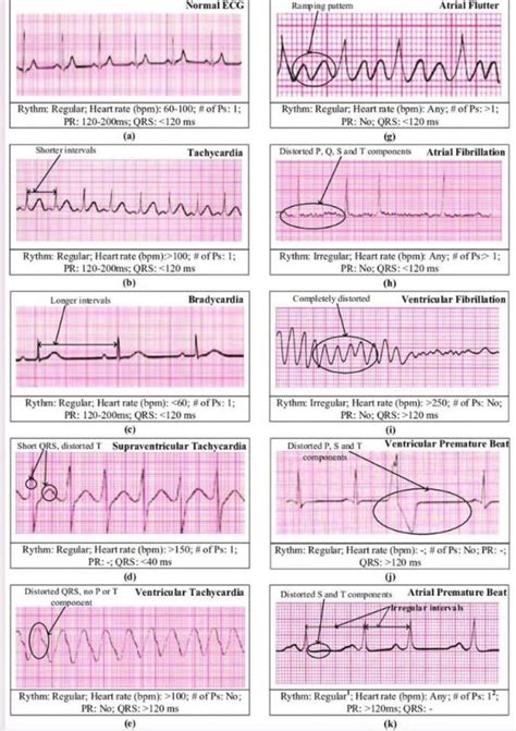 Image result for Normal vs Abnormal ECG