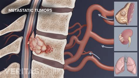 Metastatic Spine Tumors
