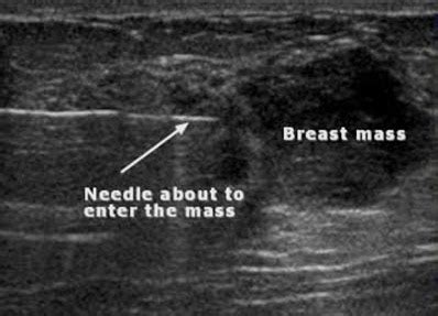 Ultrasound guided FNAC - Sky Diagnostics Delhi