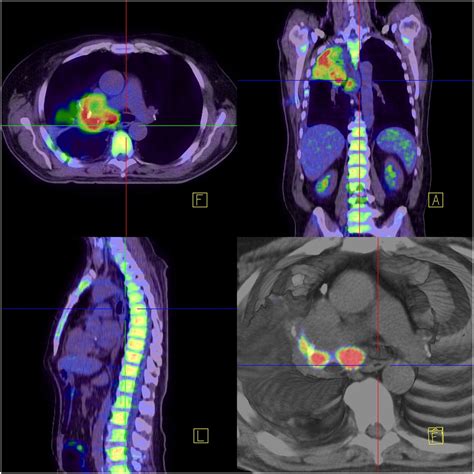 Pet Scan Images Lung Cancer