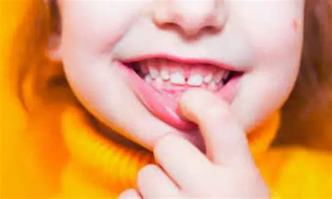 Identifying atypical deglutition in children with OSAS could help guide ...