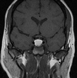 A case of symptomatic rathke`s cleft cyst in an adolescent girl ...
