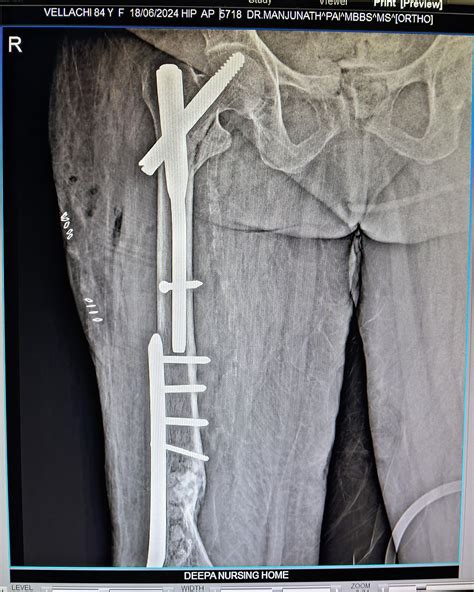 Advanced Joint Reconstruction Techniques Explained