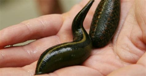 Man Complains Of Non-Stop Coughing, Doctors Find Two Leeches Inside His ...