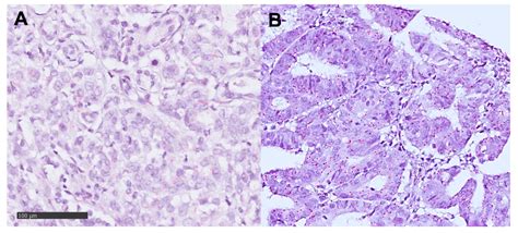 Dickkopf-2 (DKK2) as Context Dependent Factor in Patients with ...