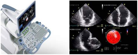 Two-Dimensional Echocardiography (2D Echo) used for excellent images of ...