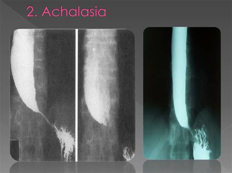 PPT - Barium Swallow PowerPoint Presentation, free download - ID:8869209