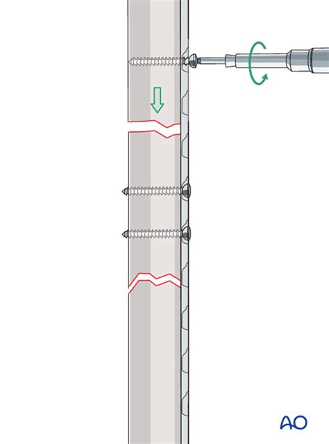Compression Take Off Plate 的图像结果