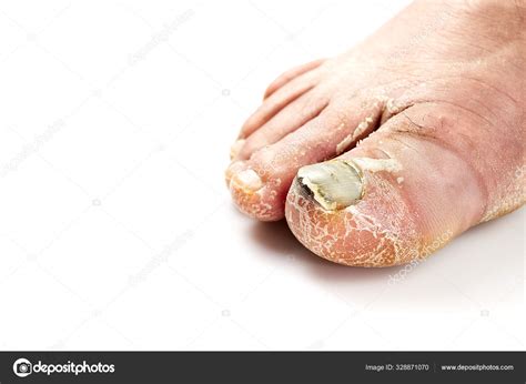 White Toenail Fungus
