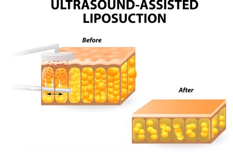 Vaser Lipo: Ultrasound-Assisted Liposuction Explained – Fat Procedures