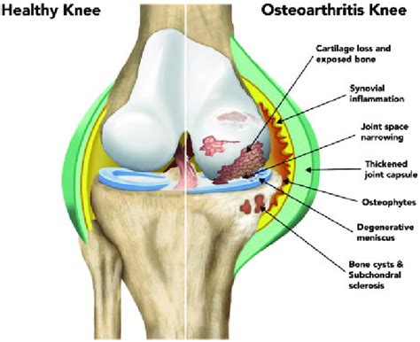 Illustration showing the key pathological features of osteoarthritis ...