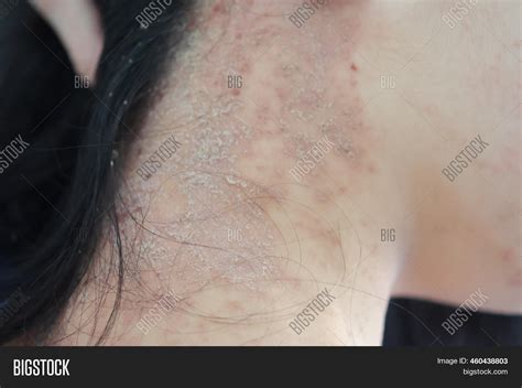 Rash On Neck From Silver Necklace at Alexis Kevin blog