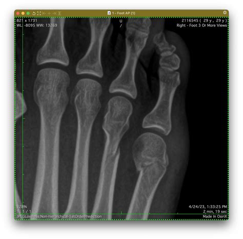 5th metatarsal head fracture : r/brokenbones