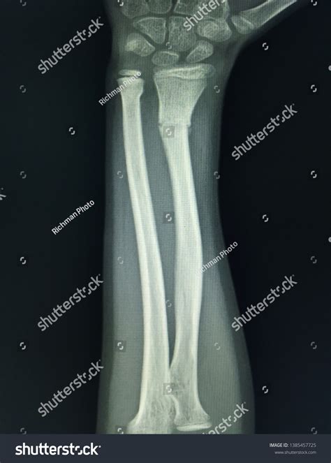 Broken Left Forearm X Ray