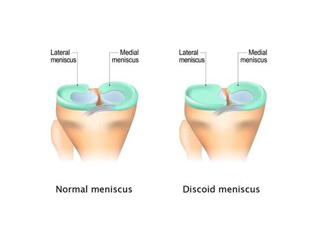 Discoid Meniscus | Johns Hopkins Medicine