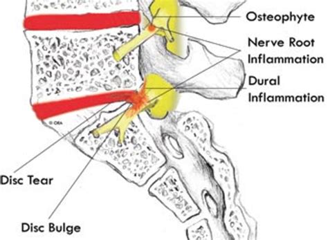 Image result for Right Side Nerve Root Block