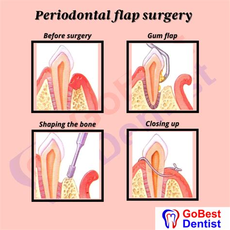 Flap Surgery & Gum Treatments - Gobest Dentist