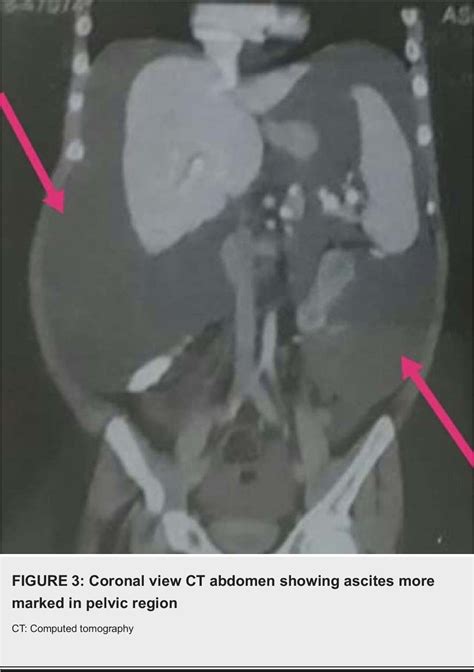 Figure 3 from Laurence-Moon-Bardet-Biedl Syndrome with Coexisting Abdominal Distension and ...