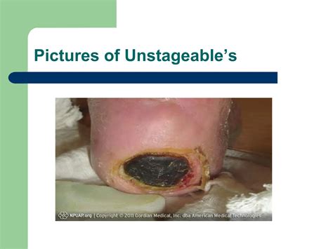 pressure-ulcers.pdffhfhfhfhfhhuhfhfhkhfhfhfuhriuhuh | PDF