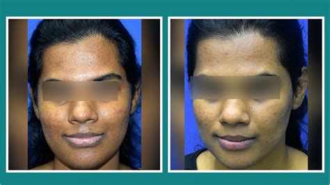 Cutis | Carbon Laser Facial