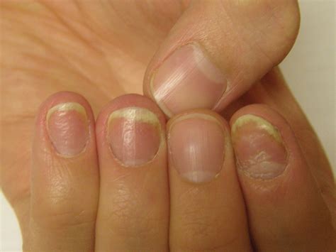 Nail Psoriasis Tips | MDedge