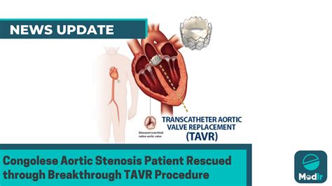 Congolese Aortic Stenosis Patient Rescued through Breakthrough TAVR ...