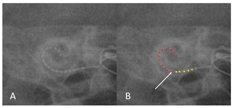 The Importance of Intraoperative Plain Radiographs during Cochlear ...