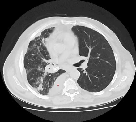 Case report of neglected obstructive pneumonia
