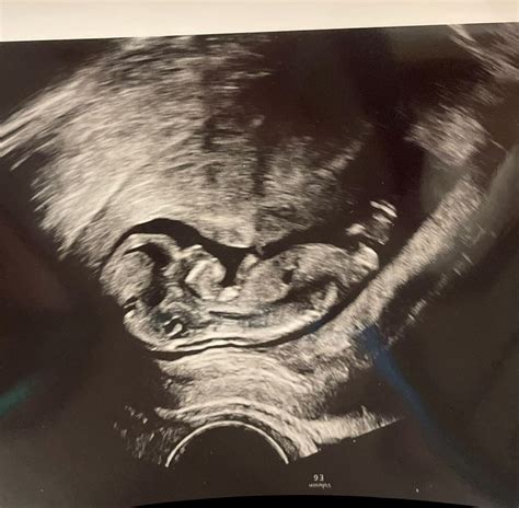 11 Week Ultrasound | BabyCenter