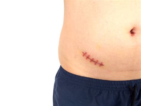 Image result for Appendix Surgery Scar