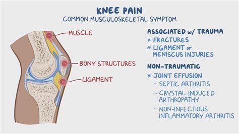 Joint Effusion Treatment Knee Effusion Synovitis Volume Measurement