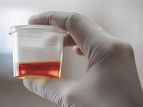 Urine Color and its indication of health problems check your urine ...