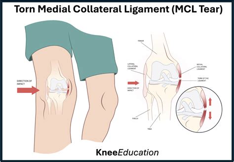 Medial Collateral Ligament Tear -MCL Tear - Knee Education