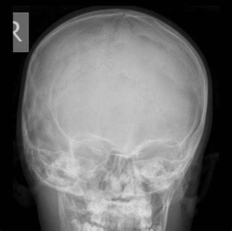 FRONTAL BONE FRACTURE | Buyxraysonline