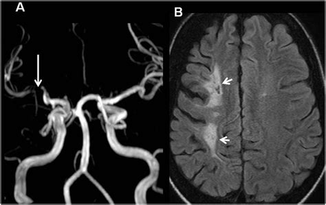 Transient ischaemic attacks: mimics and chameleons | Practical Neurology