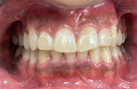 White Spots On Gums Under Teeth at Tyler Mckinley blog