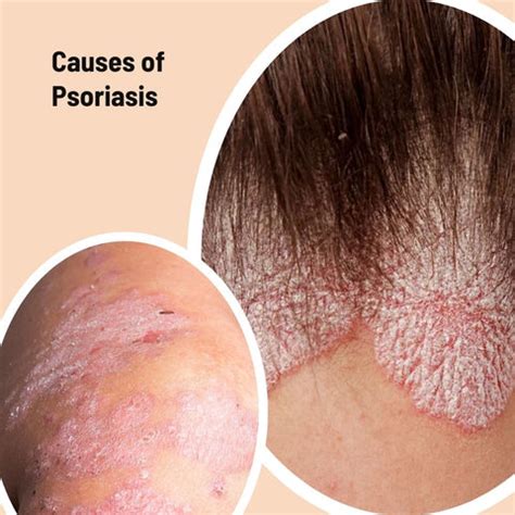 Scalp Psoriasis vs. Dandruff: Treatment & Symptoms | Clinikally