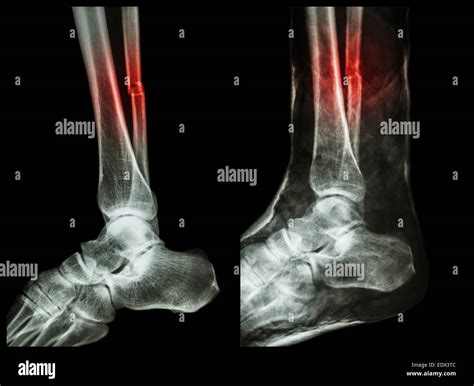 Broken Ankle Xray