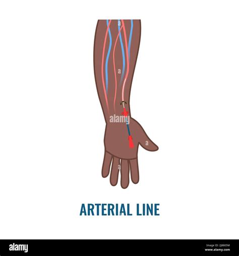 Arterial line catheter, illustration Stock Photo - Alamy