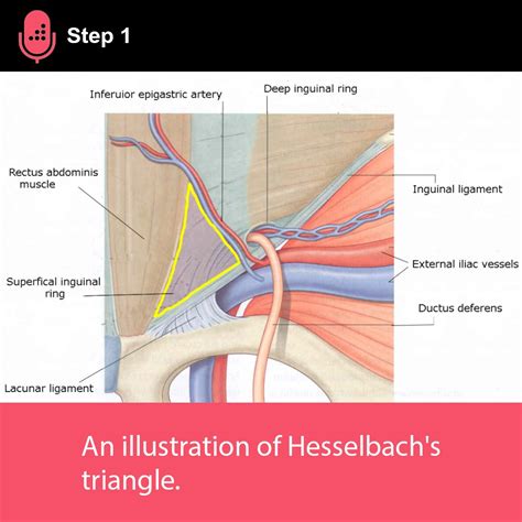 Internal Inguinal Ring