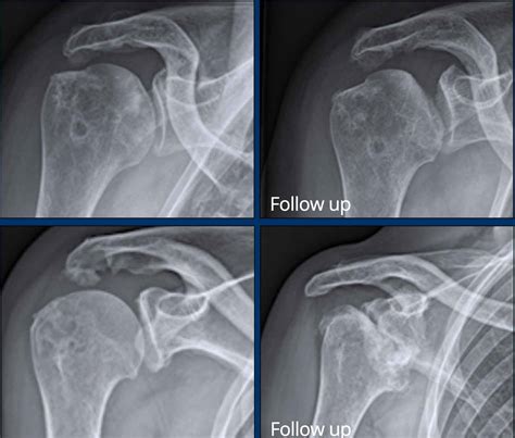 X Ray Shoulder Arthritis UW Shoulder And Elbow Academy: Rheumatoid