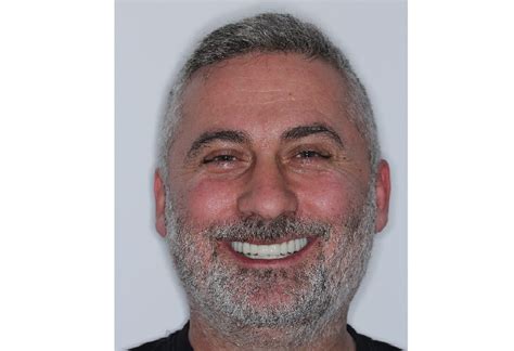 İmplant Tedavisi | Başakşehir Ortodonti