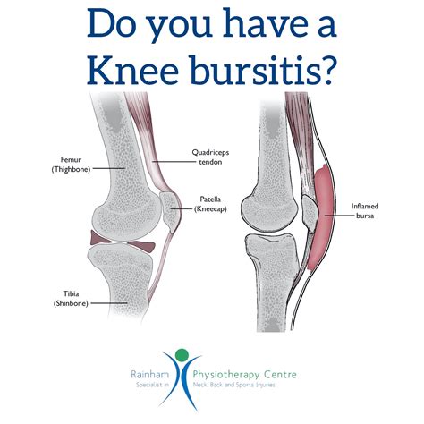 How To Treat Bursitis In The Knee | McGear Hub