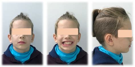 The Interdisciplinary Orthodontic–Surgical Diagnostic and Treatment ...