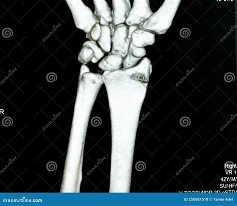 CT Scan Right Wrist Joint 3D View Shows Right Distal Radius Fracture ...