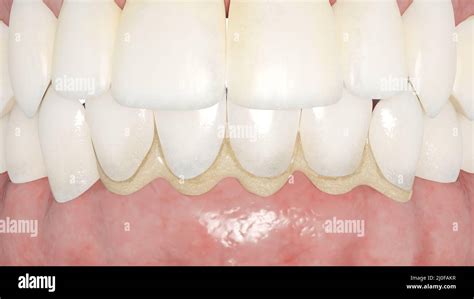 Image result for Tooth Calculus